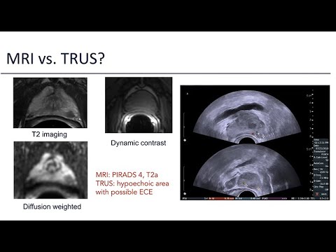 Localized Prostate Cancer Cases - 2021 Prostate Cancer Patient Conference