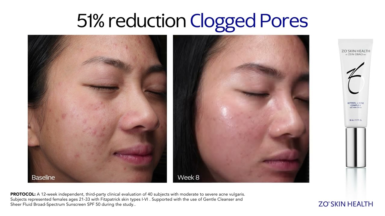 Retinol + Acne Complex