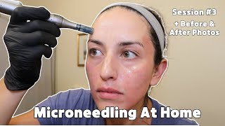 Microneedling at Home w/ Dr. Pen M8S 💉 | Before & After Results!
