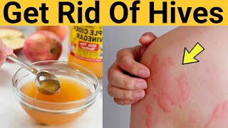 Home remedy to get rid of hives naturally and fast - stop hives from itching and spreading