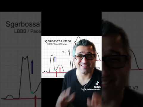 sgarbossa's criteria made easy.