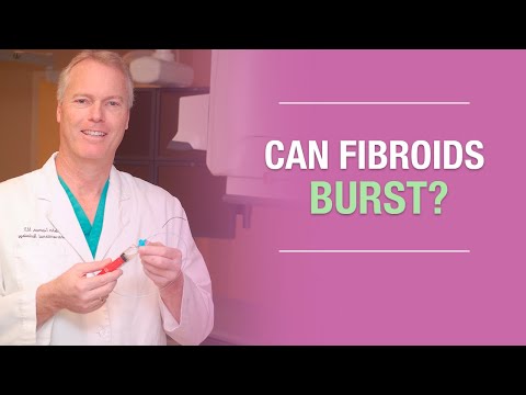 Ask Dr. John Lipman: Can Fibroids Burst?