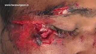 Take Care and Wear a Helmet and Avoid Such Facial Injuries