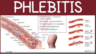Phlebitis Explained: Types, Causes, Classification, Symptoms, and Management