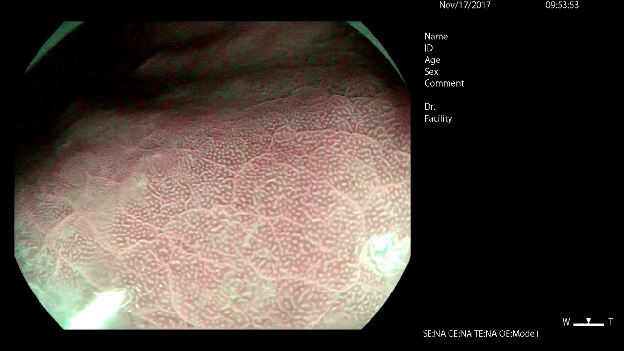 H. pylori Diagnosis with Magnifying Endoscopy - YouTube