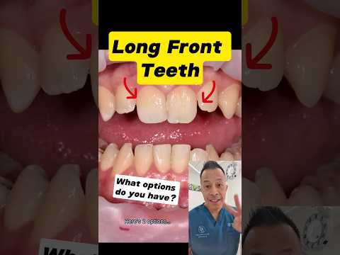 Fixing Long Front Teeth: Top 2 Options! #dentallan #dentist #shorts