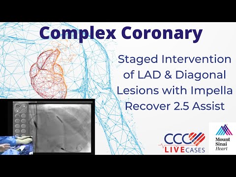 Staged Intervention of LAD & Diagonal Lesions w/ Impella Recover 2.5 Assist -June 2011 Webcast Video