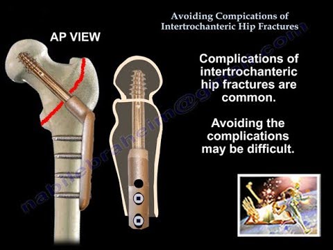 Avoiding Complications Intertroch.  Hip Fractures - Everything You Need To Know - Dr. Nabil Ebraheim