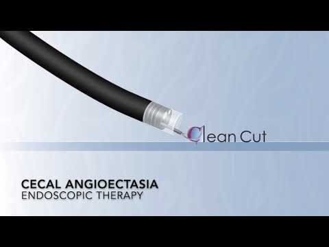 Colon: Cecal Angioectasia Management