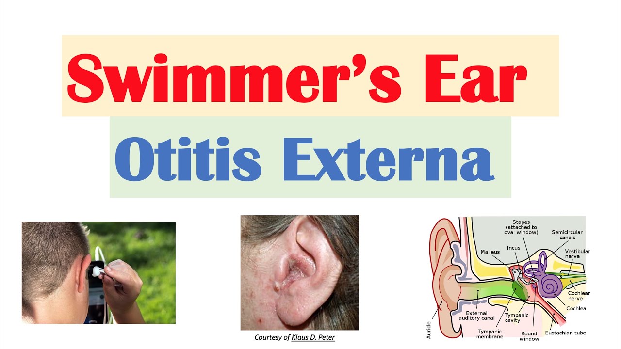 Swimmer’s Ear (Otitis Externa) | Risk Factors, Causes, Signs & Symptoms, Diagnosis, Treatment