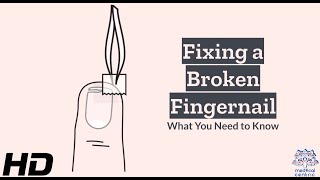 Broken Fingernail Remedies: Get Your Nails Back in Shape