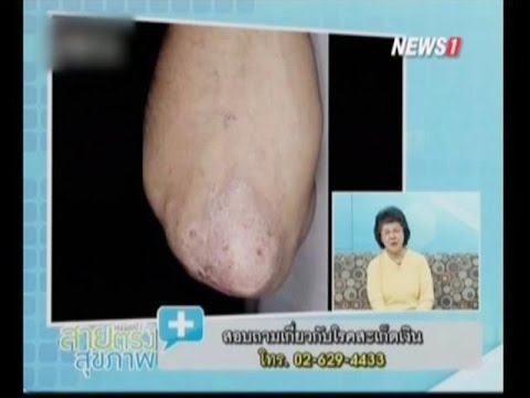 โรคสะเก็ดเงิน pilnova อาการ โรคสะเก็ดเงินก่อนและหลังภาพถ่าย