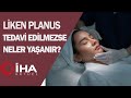 Liken Planus Tedavi Edilmezse Neler Yaşanabilir