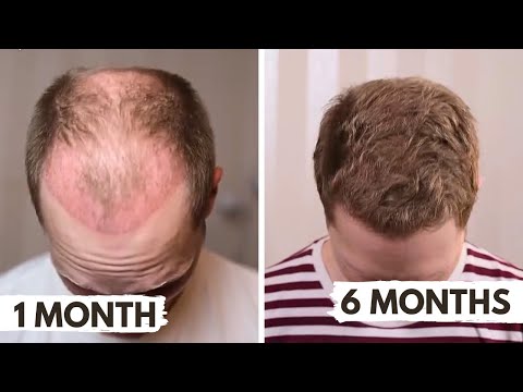 Resultat månad för månad - första halvåret