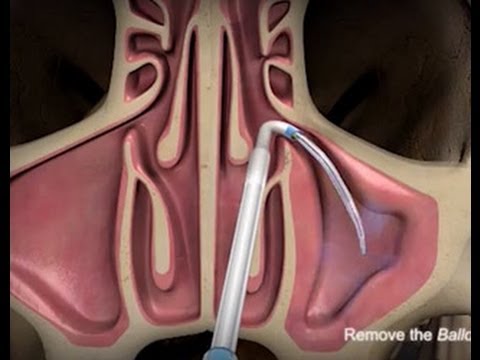 Balloon Sinuplasty Procedure with ENT Dr. Timothy Ragsdale