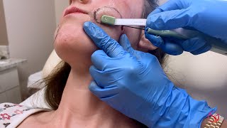 Non-Surgical Buccal Fat Removal at The Dermatology, Laser & Vein Center
