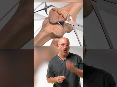 Shattered Kneecap 🔨 Repair #shorts