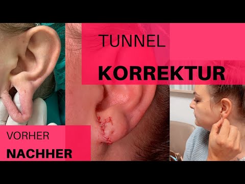 Fleshtunnel entfernen