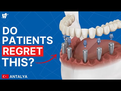 All on 6 Dental Implants in Antalya: UK Patients Review Full Mouth Implants in Turkey