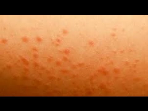 Гонартроз коленного сустава 3 степени операция стоимость Лекарство от хондроза шейного позвоночника