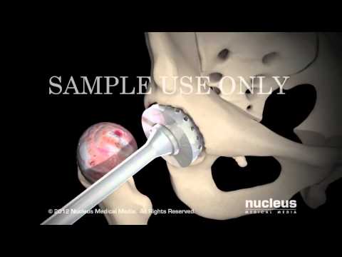 Picture hip MRI Chirurgia dellanca quanto a San Pietroburgo