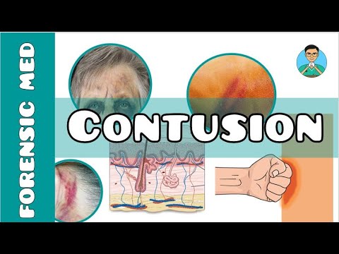 Contusion | What is a contusion injury | What causes of bruising | What are the types of bruises?