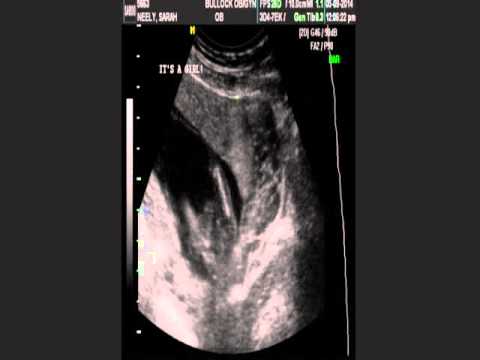 15 Weeks Pregnant Ultrasound determines it's a girl!!