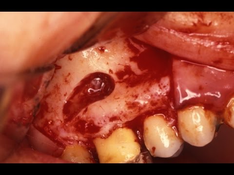 Halamang-singaw kuko sa paa na may mga larawan Napatunayan na paraan ng paggamot ng kuko halamang-singaw