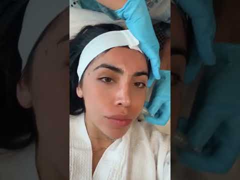 MicroChanneling Facial Treatment