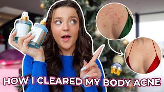The TRUTH About How I Got Rid of My Body Acne 2022 | Truly Beauty