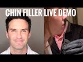 Chin Fillers: Live Demo with Explanation