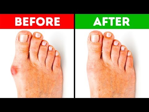 Treating Bunions without Surgery is Easier than You Think