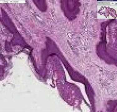 Cancer cervical biodescodificacion