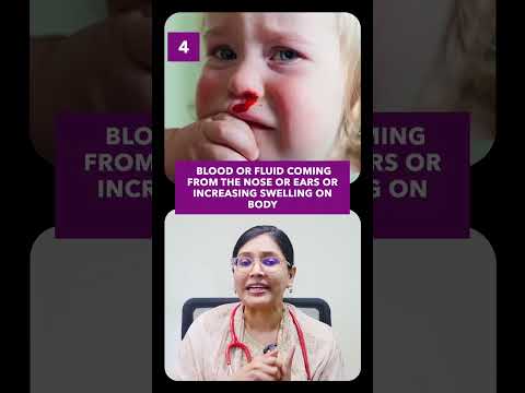 Head injury in baby when to worry? | Dr Anusha Rao #headinjury #babyhealth