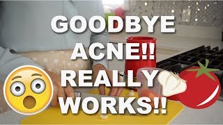 BEST HOME REMEDY FOR GETTING RID OF ACNE!!