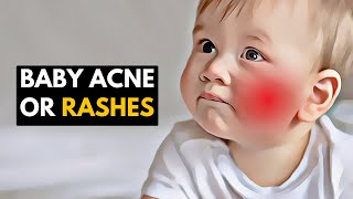Gentle Care for Little Faces: Managing Baby Acne and Rashes