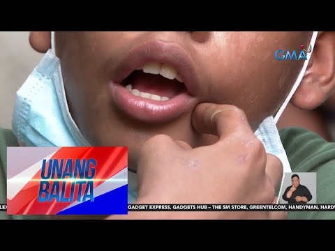 PHL Dental Assoc. – 72% ng mga Pinoy, may bulok na ngipin UB