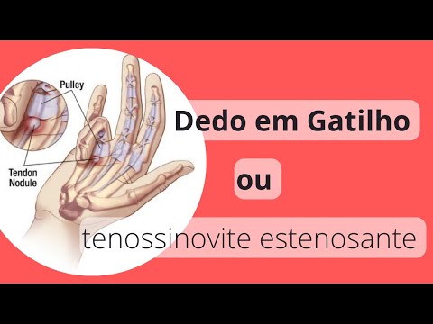 Dedo em Gatilho - oque é, como resolver - Tenossinovite estenosante