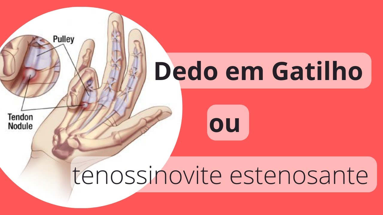 Dedo em Gatilho - oque é, como resolver - Tenossinovite estenosante