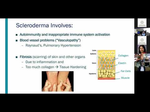 Overview of Juvenile Systemic Sclerosis