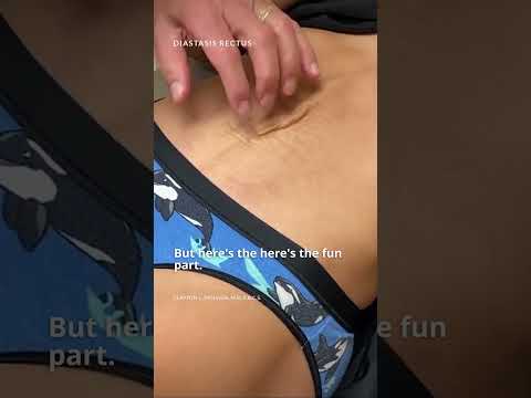 Extreme Diastasis Rectus! #tummytuckprocedure