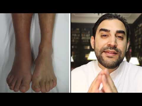 Tödlicher Notfall Thrombose! Die typischen Anzeichen einfach erkennen und handeln! | Dr. Alawi