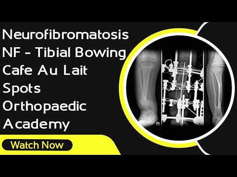 Neurofibromatosis