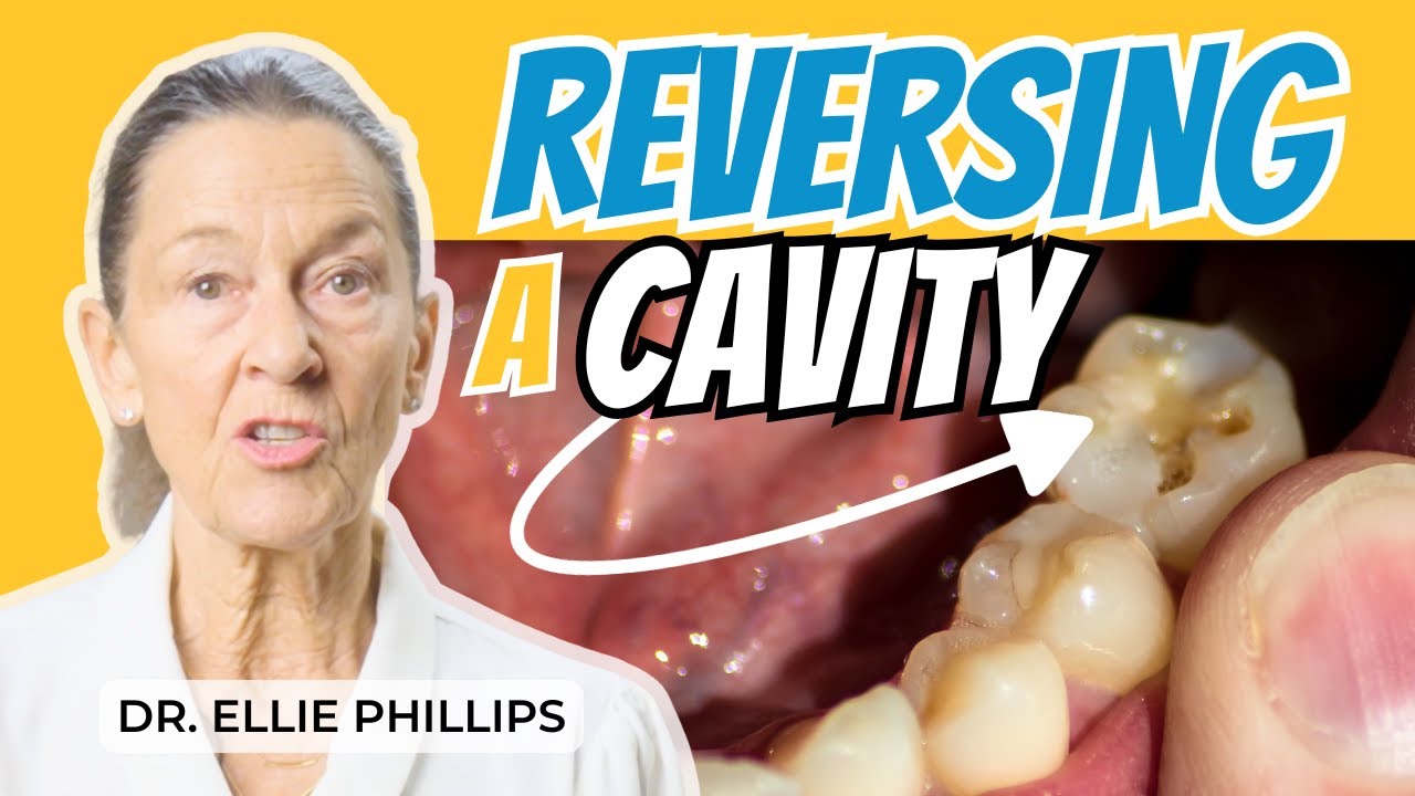 How to Reverse a Cavity & Prevent Future Cavities