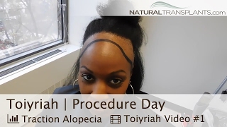 Female Hair Loss | Traction Alopecia Hair Transplant (Toiyriah)