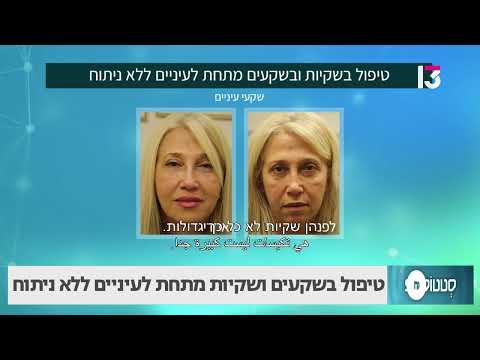 טיפול בשקעים ושקיות מתחת לעיניים ללא ניתוח