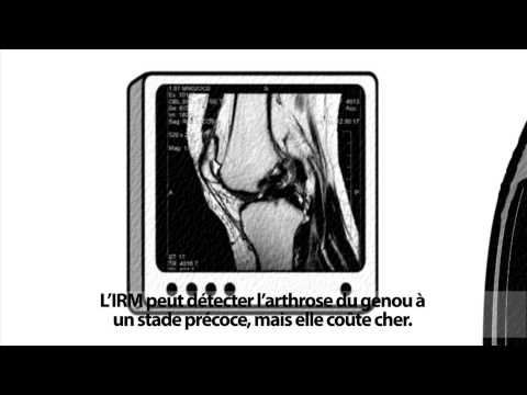 comment soigner et soulager l'arthrose