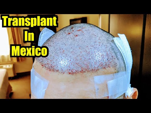 2nd Mexican Hair Transplant FUE-Hair Medical...