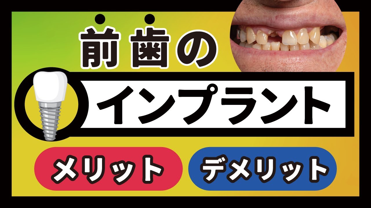 前歯にインプラント治療をするのは難しい?治療選択は慎重にしましょう!