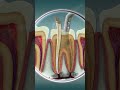 Root Canal Treatment Curveia Dental I RCT